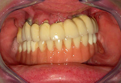 Rehabilitació completa fixe maxilar sobre implants amb dents de ceràmica