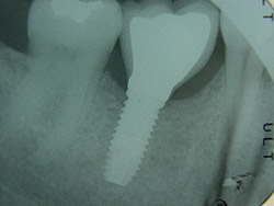 Implant unitari a la mandíbula