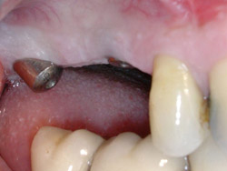 03.ImplantsSectorPosteriorMaxil.ar04