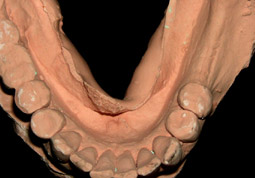 04.ImplantsCirconia-aMandibula01