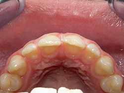 Tancament de diastemes anteriors amb composite