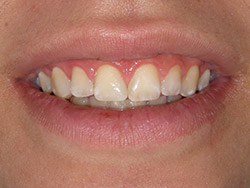 Tancament de diastemes anteriors amb composite