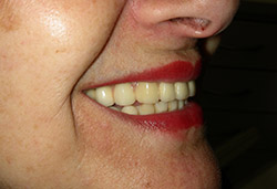 Rehabilitació completa fixe maxilar sobre implants amb dents de ceràmica