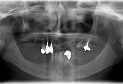 Rehabilitació completa fixe amb dents de resina