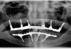 Rehabilitació completa fixe amb dents de resina