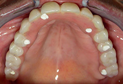 Rehabilitació completa fixe amb dents de resina