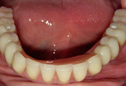 Rehabilitació completa fixe amb dents de resina