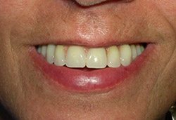 Rehabilitació completa fixe amb dents de resina
