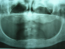 Pròtesi removible "obredentadura" inferior amb implants