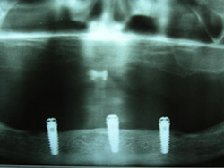Pròtesi removible "obredentadura" inferior amb implants