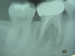 Implant unitari a la mandíbula